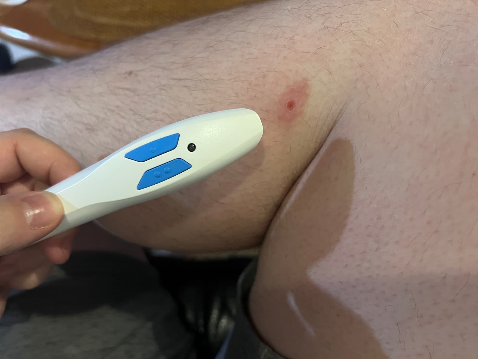 Bite Away Review: Instant Mosquito Bite Relief Pen